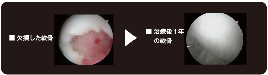 軟骨の変化