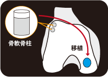 自家骨軟骨柱移植術