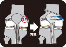 MPFL（内側膝蓋大腿靱帯）再建術