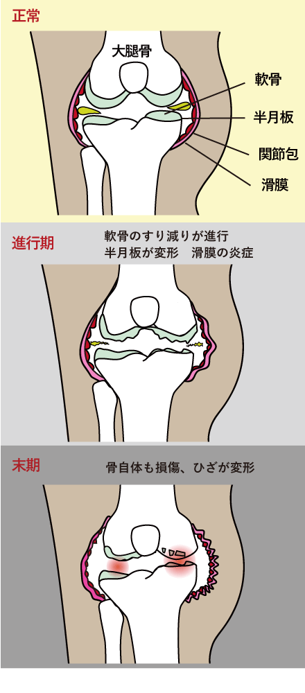 膝蓋骨骨折