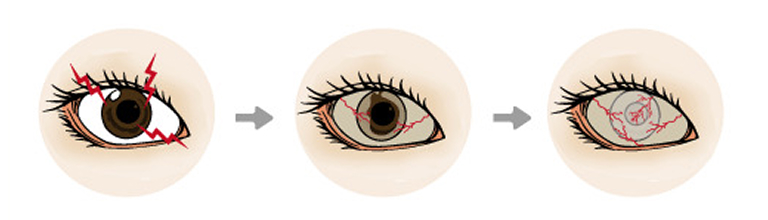 角膜上皮幹細胞疲弊症のイメージイラスト