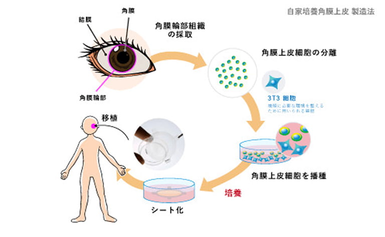自家用膜上皮の製造法