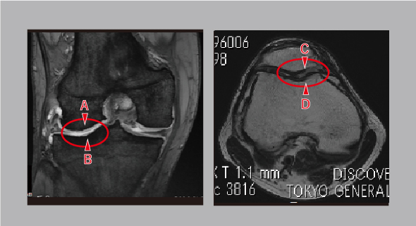 1年2ヵ月後のMRI画像