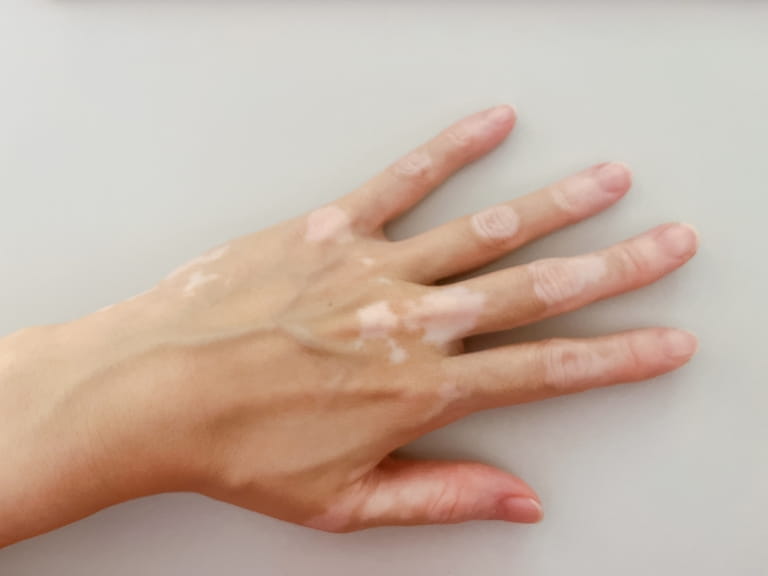 自家培養表皮やメラノサイト含有自家培養表皮を中心に、治療の考え方やFAQなど「皮膚の再生医療」に関する情報を発信しています。