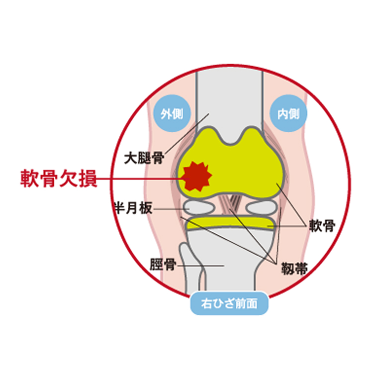 軟骨欠損のイラスト