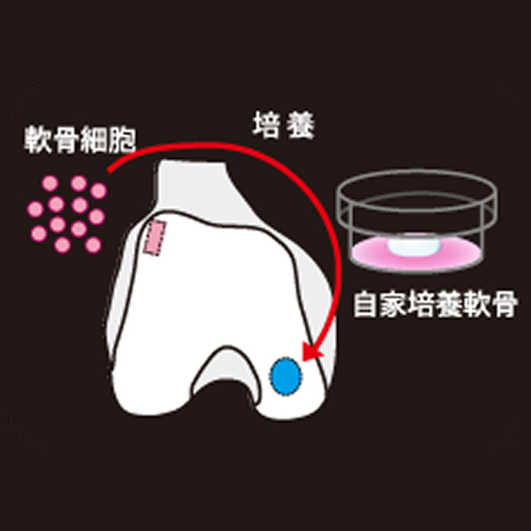 自家培養軟骨の解説イラスト