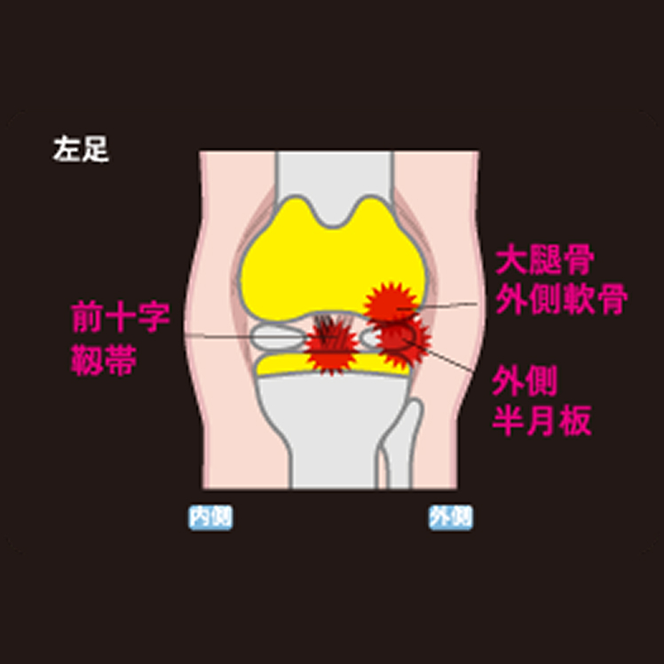 自家培養軟骨移植術 損傷事例と手術事例