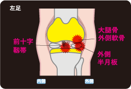 自家培養軟骨移植術 損傷事例と手術事例の解説イラスト