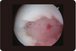 関節鏡による検査画像