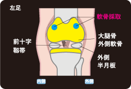 自家培養軟骨移植術 損傷事例と手術事例の解説イラスト
