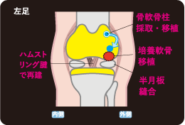 自家培養軟骨移植術 損傷事例と手術事例の解説イラスト