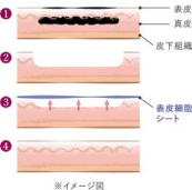 自家培養表皮 イメージ図