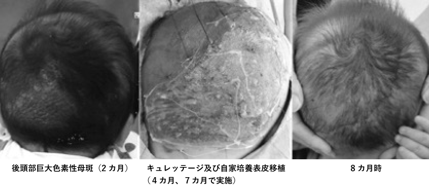 頭部巨大色素性母斑をキュレッテージと自家培養表皮で治療した症例